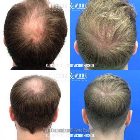 Hair replacement surgery before and after images