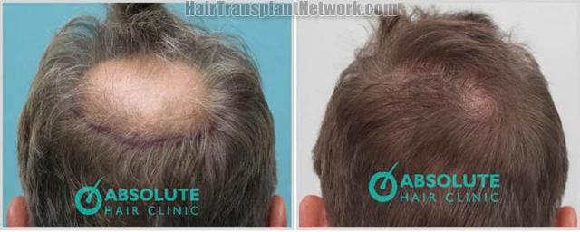 Hair restoration procedure before and after results