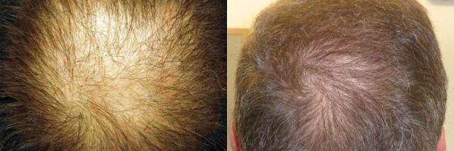 Hair replacement surgery before and after images