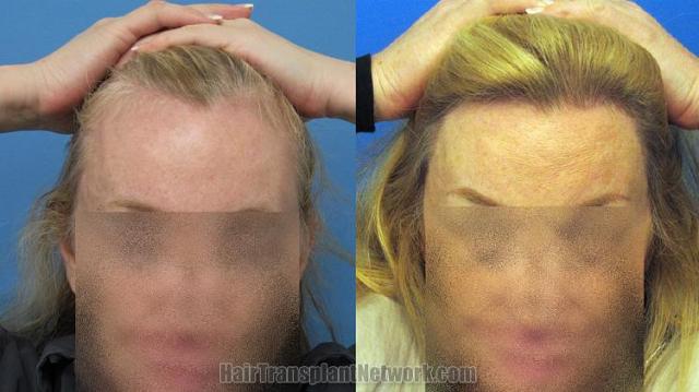 Hair restoration procedure before and after results