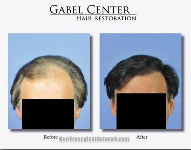 Hair restoration procedure before and after results