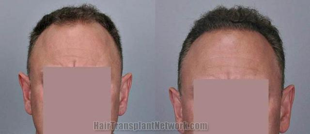 Hair restoration procedure before and after results