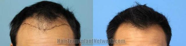 Hair restoration procedure before and after results