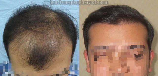 Hair transplantation surgery before and after images