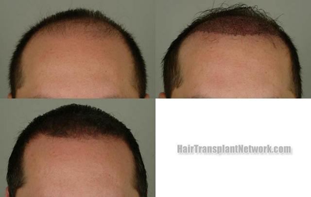 Hair transplantation surgery before and after images