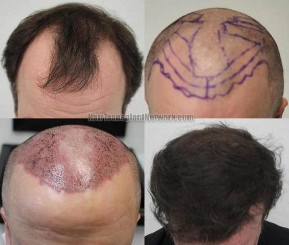 Hair restoration procedure before and after results