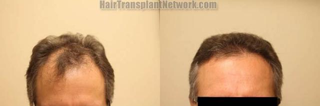 Hair restoration procedure before and after results