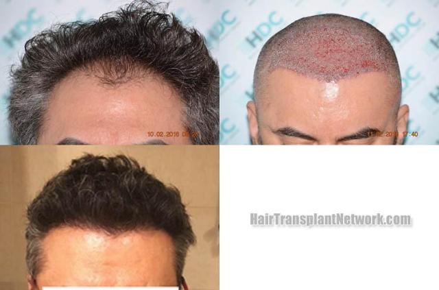 Before and after hair transplantation surgery