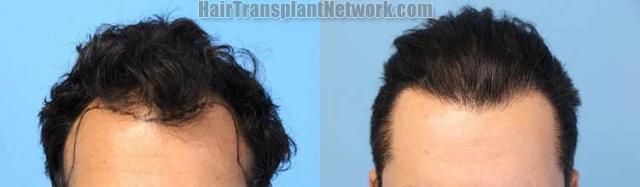 Front view - Before and after hair transplantation surgery