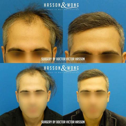 Front view - Before and after hair restoration procedure