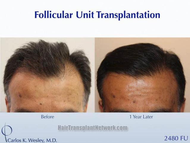 Before and after hair restoration procedure images