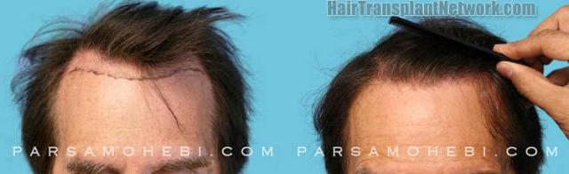 Before and after hair restoration procedure images