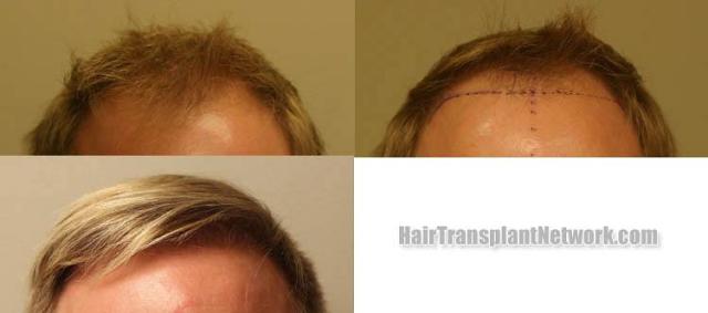 Front view - Before and after hair restoration procedure