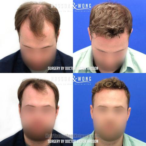 Front view - Before and after hair restoration procedure