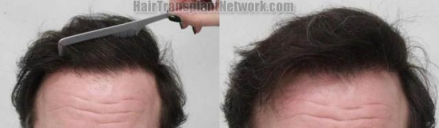 Hair restoration procedure before and after results