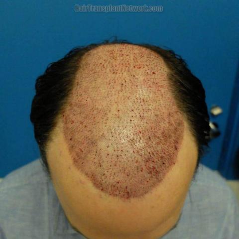 Hair restoration surgery before and after photos