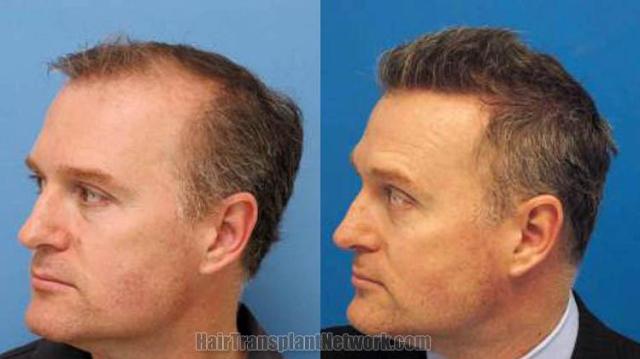 Hair transplantation surgery before and after photos