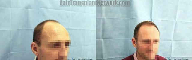 Hair transplantation surgery before and after images