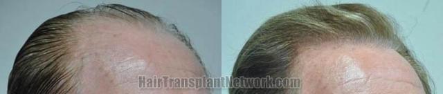 Hair transplantation surgery before and after photos