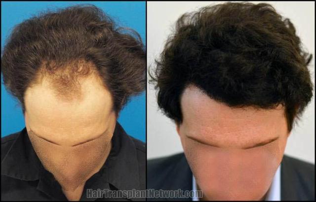 Hair transplantation surgery before and after photos