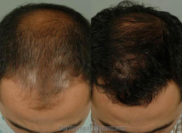 Hair restoration procedure before and after pictures