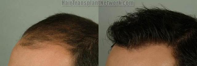 Hair transplantation surgery before and after images