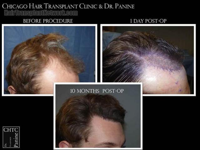 Hair transplantation surgery before and after pictures