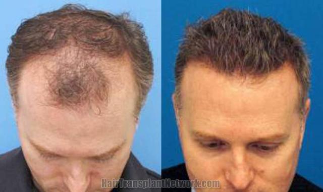 Top view before and after hair restoration results