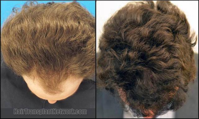 Top view before and after hair restoration results