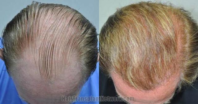 Before and after hair transplant procedure images