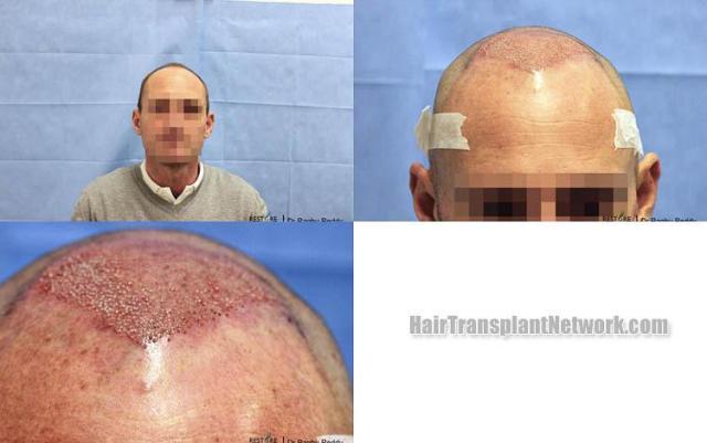 Hair restoration procedure before and after results