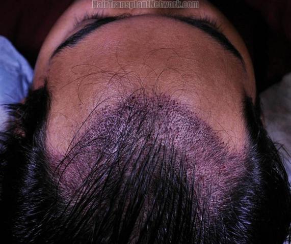 Hair transplant surgery before and after photos