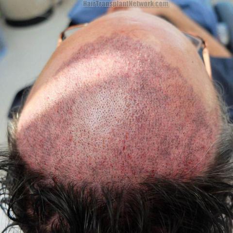 Surgical hair transplantation result photographs