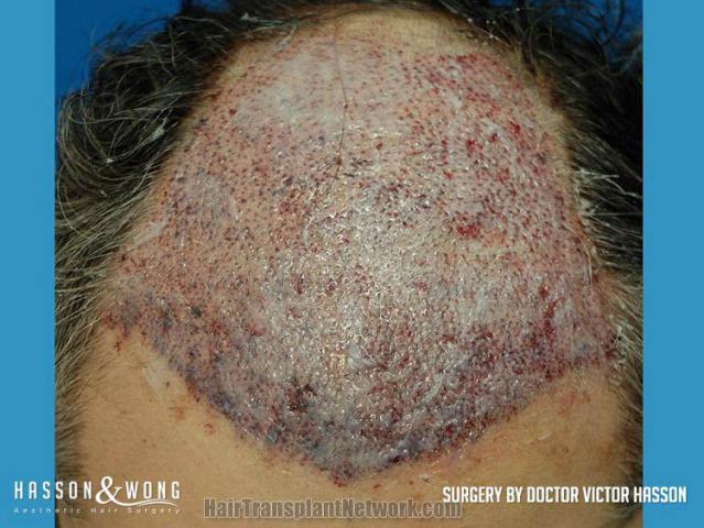 Surgical hair transplantation result photographs