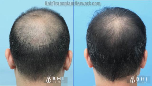 Surgical hair transplantation result photographs