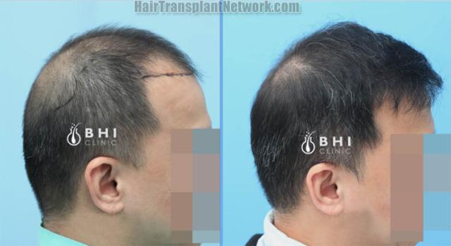 Hair restoration procedure before and after results