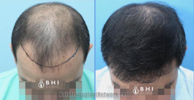 Hair restoration procedure before and after results