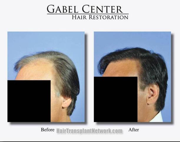 Hair transplantation surgery before and after pictures