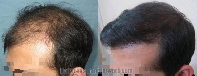 Hair transplantation surgery before and after photos