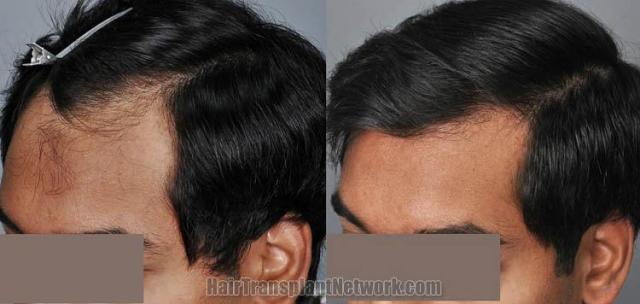 Hair transplantation surgery before and after images