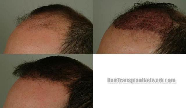 Hair transplantation surgery before and after photos