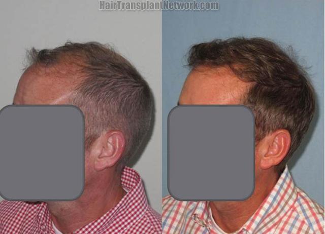 Hair transplantation surgery before and after pictures