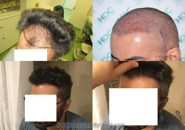 Hair restoration procedure before and after pictures