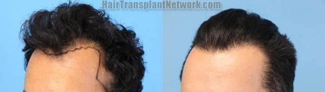 Hair restoration procedure before and after pictures