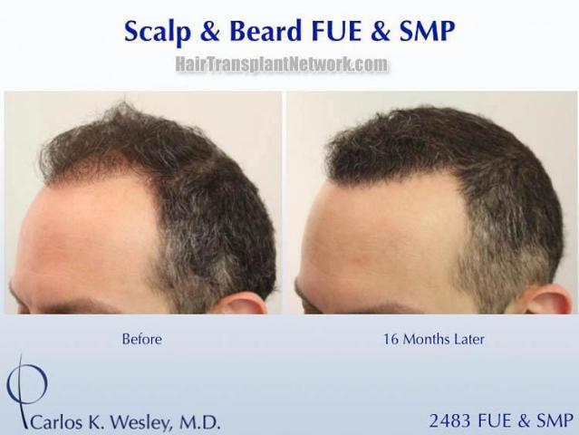 Hair restoration procedure before and after pictures