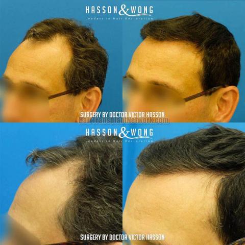 Hair transplantation surgery before and after photos