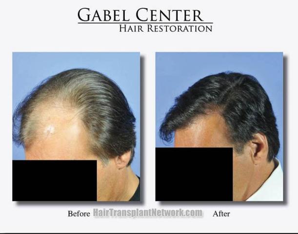 Hair transplant surgery before and after photos