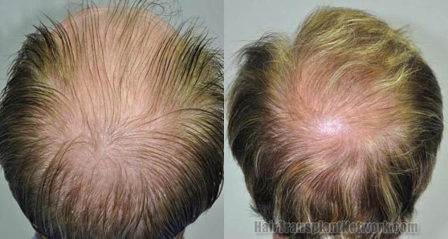 Hair transplantation surgery before and after pictures