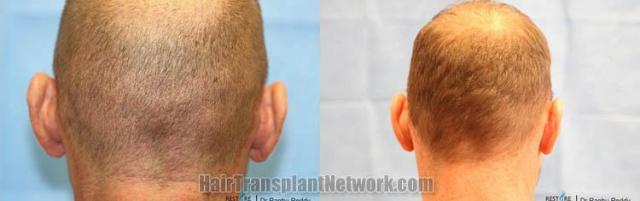 Hair restoration procedure before and after pictures