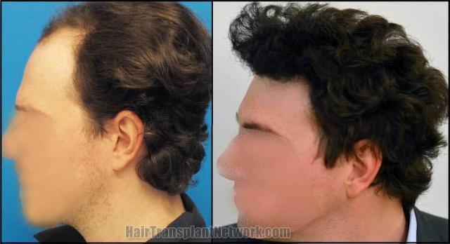 Before and after hair transplantation result photographs